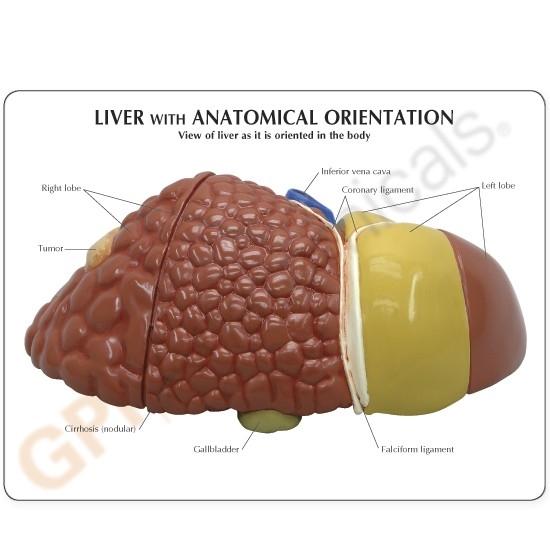 Human Diseased Liver (Cancer) Anatomy Model - Detailed Medical Study Tool for Doctors, Students & Researchers | Perfect for Medical Education, Diagnosis Practice & Pathology Studies