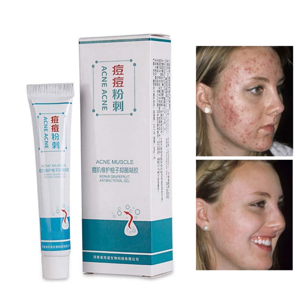 KISSION Acne Gel - Fast-Acting Acne Spot Treatment & Skin Repair Cream for Face & Body | Redness Relief Ointment | Perfect for Teen & Adult Acne Care, Post-Breakout Recovery & Sensitive Skin Soothing