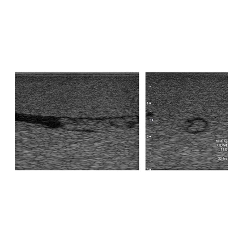 Deep Vein Thrombosis (DVT) Training Phantom Model - Medical Simulation Device for Ultrasound Practice & Vascular Diagnosis Training