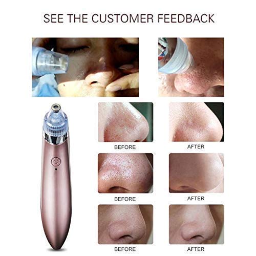 Divik Acne Pore Cleaner Vacuum - Blackhead Remover Kit for Women & Men - Perfect for Daily Facial Care
