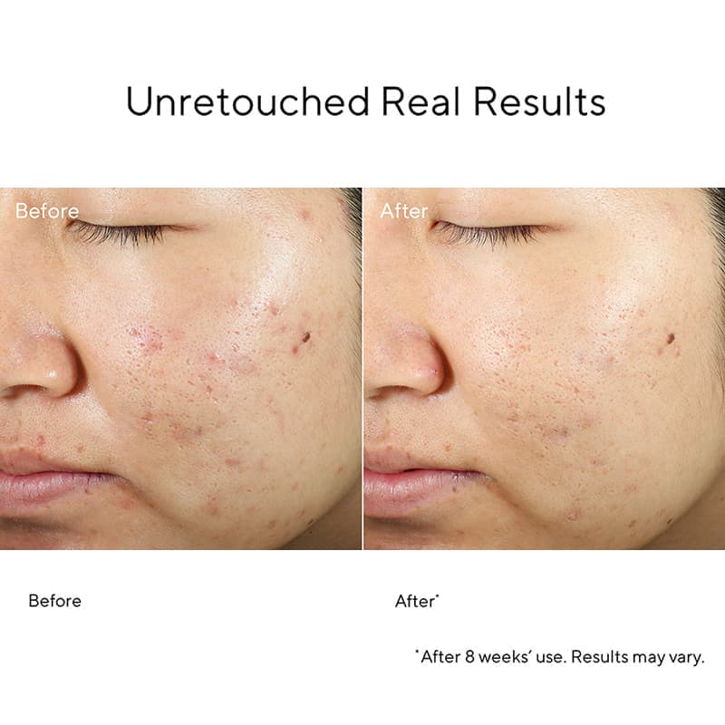 Murad Blemish Control InvisiScar Resurfacing Treatment for Acne Scars & Dark Spots - Skin Renewal Solution for Face & Body - Perfect for Post-Acne Care & Evening Skin Tone