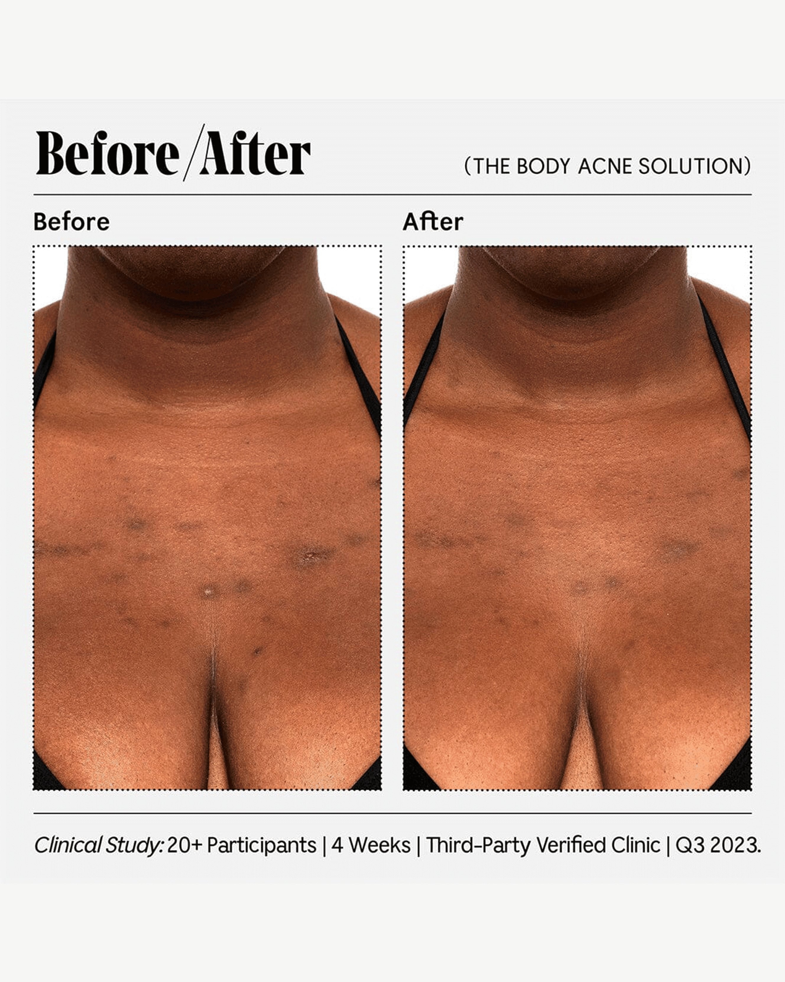 Best Acne Treatment for Body - Clear Breakouts Fast with Dermatologist-Recommended Solution | Perfect for Back, Chest & Shoulder Acne