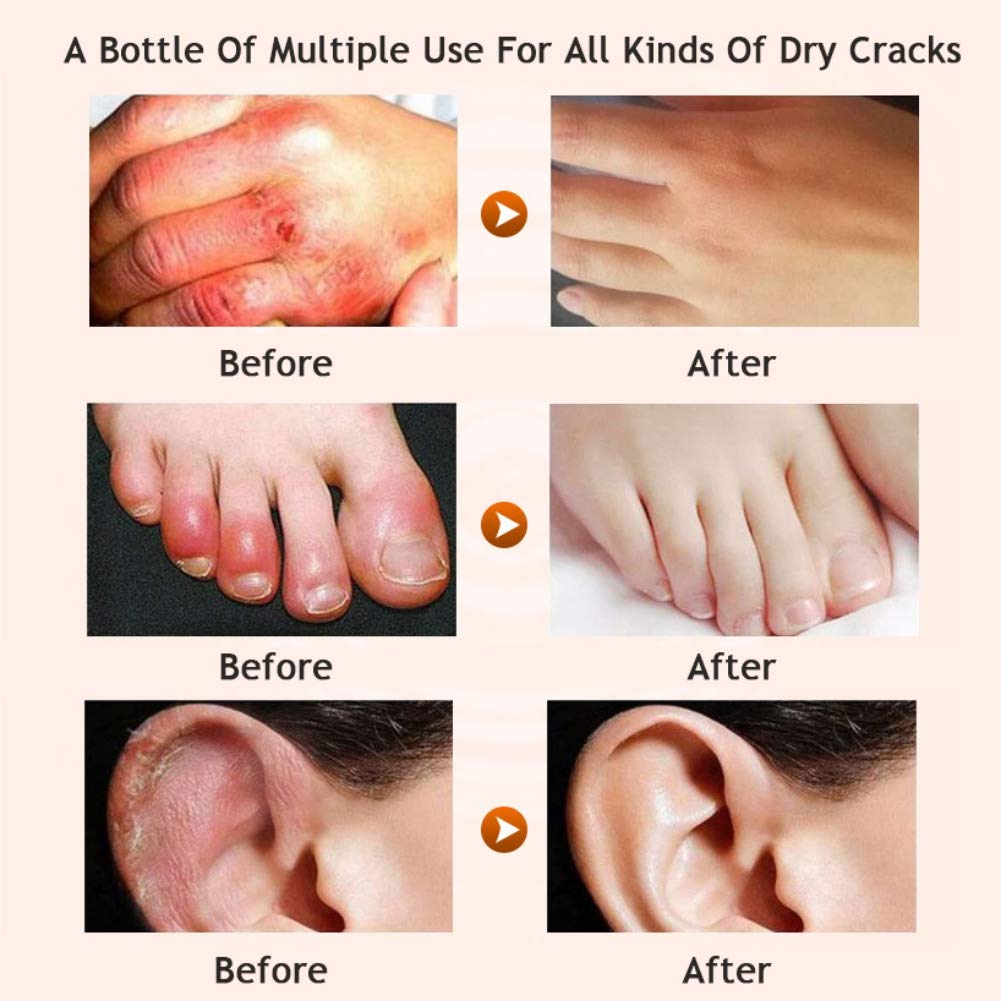 Allbestaye Horse Oil Foot Cream for Dry Cracked Heels - Intensive Repairing Moisturizer for Rough & Chapped Feet - Best for Cracked Heel Treatment & Foot Care at Night