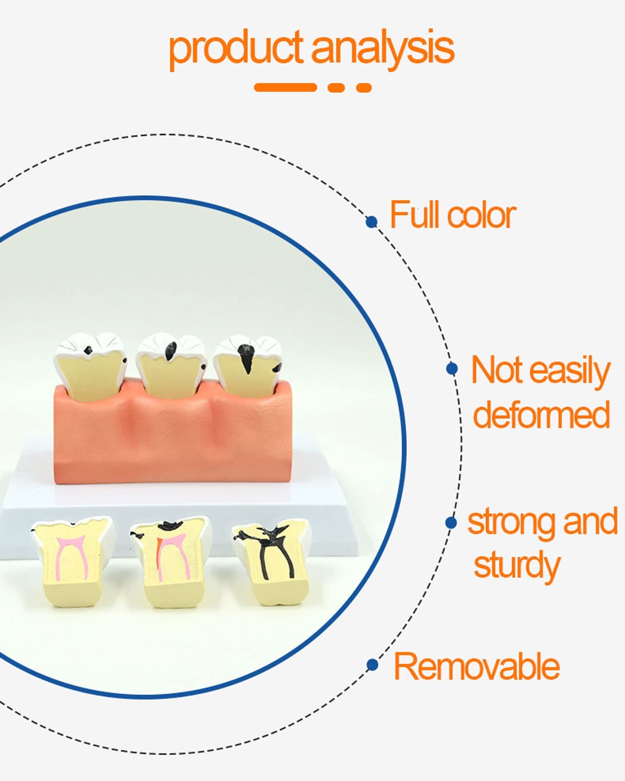 **Removable Dental Teeth Model - Caries & Tooth Decay Demonstration Kit for Dental Education, Teaching & Oral Health Training - Perfect for Dentists, Students & Classroom Learning**    *(Ideal for dental schools, clinics, patient education & hands-on training!)*