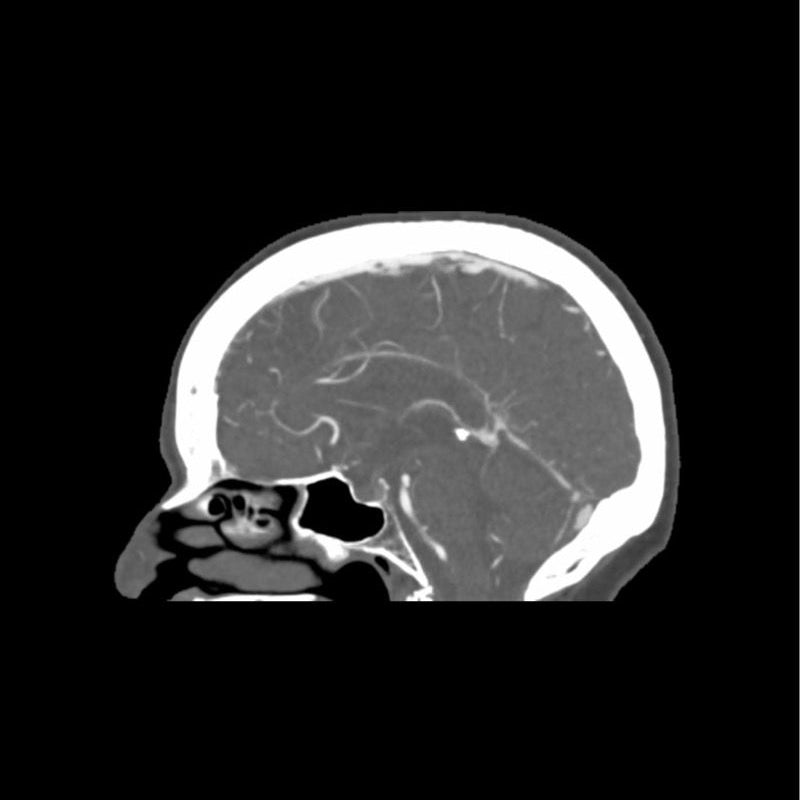 CTA Aneurysm Head Phantom for CT Scan and X-Ray Training - High-Quality Medical Simulation Tool for Radiology Education and Diagnostic Practice