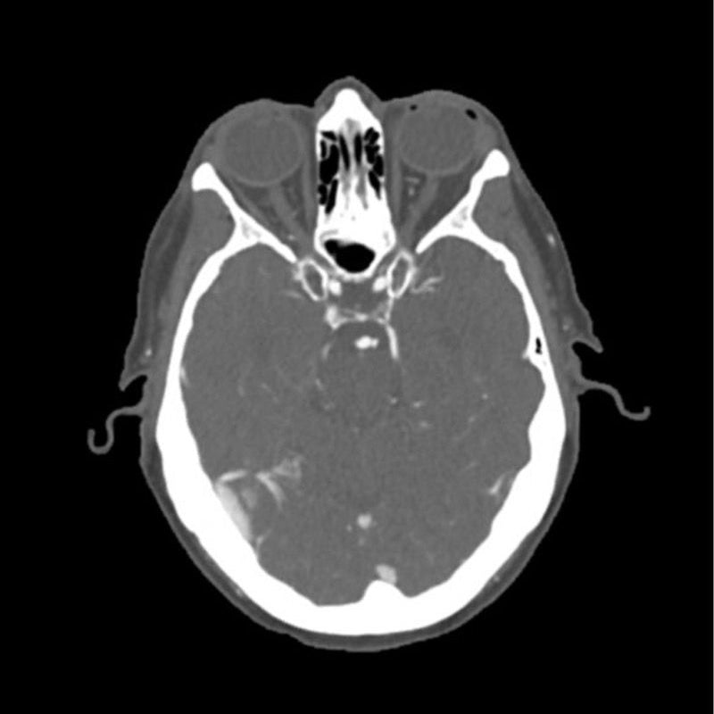CTA Aneurysm Head Phantom for CT Scan and X-Ray Training - High-Quality Medical Simulation Tool for Radiology Education and Diagnostic Practice