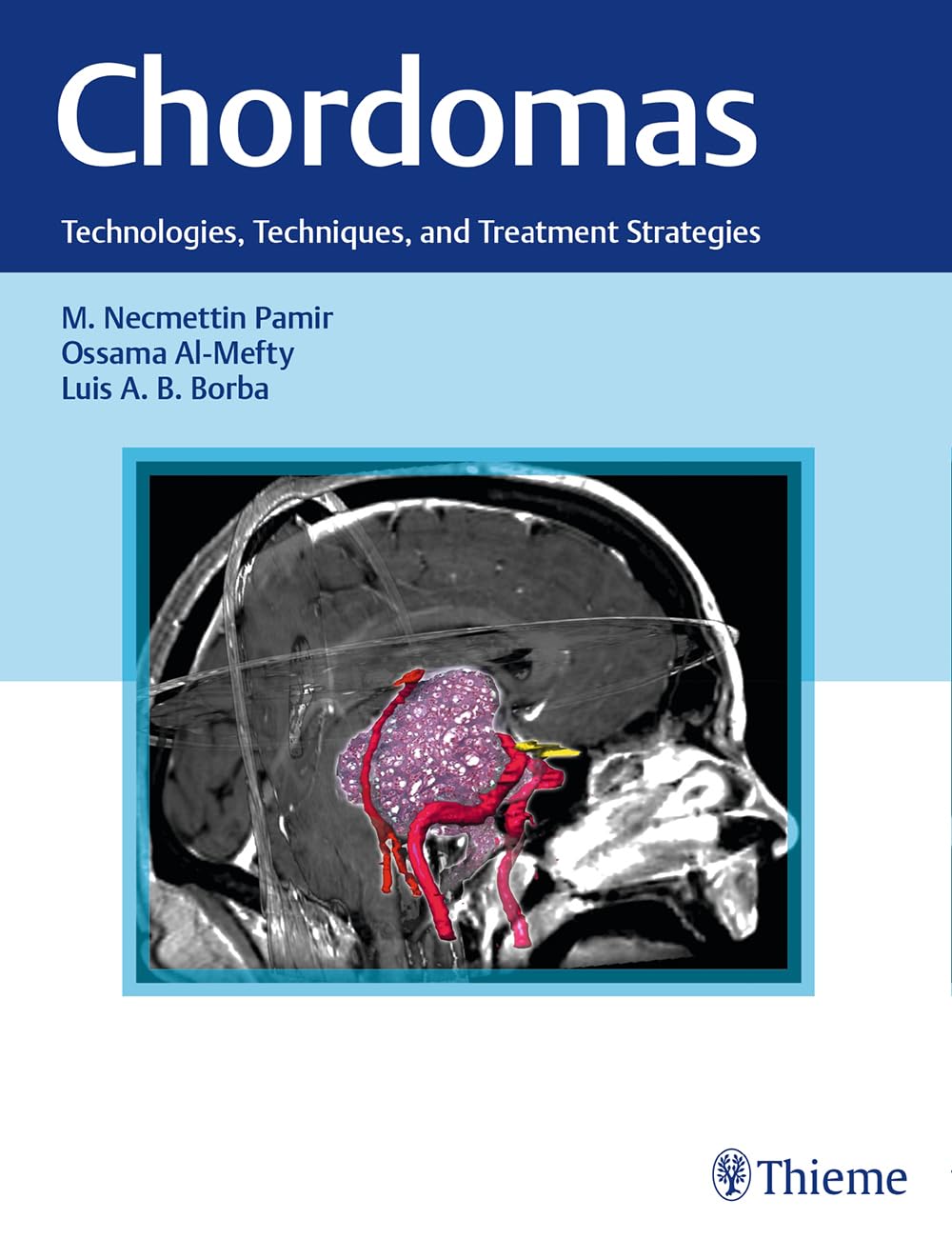 Chordomas: Advanced Technologies, Surgical Techniques & Treatment Strategies for Spinal and Skull Base Tumors - Ideal for Neurosurgeons and Oncologists