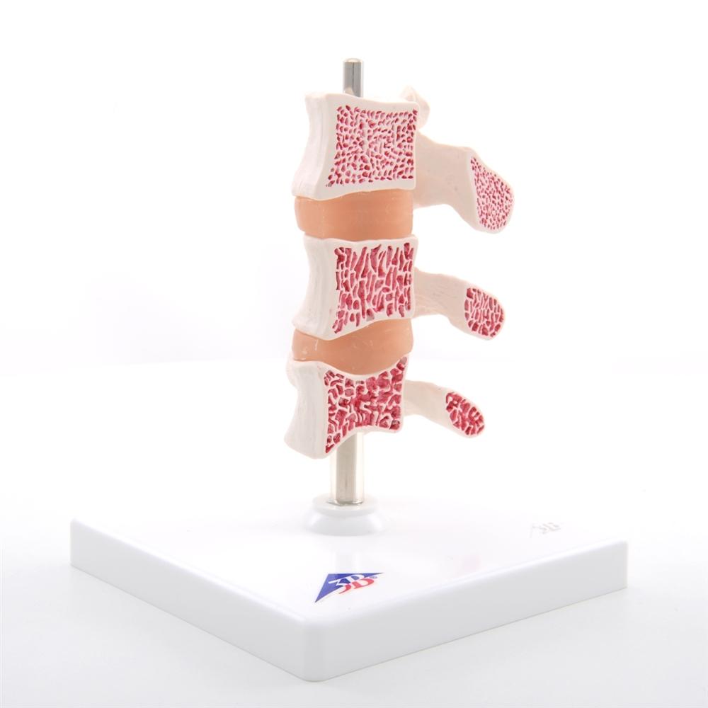 Premium Osteoporosis Bone Model - Anatomically Accurate Skeletal Display for Medical Education & Patient Demonstration - Perfect for Classrooms, Clinics, and Healthcare Training