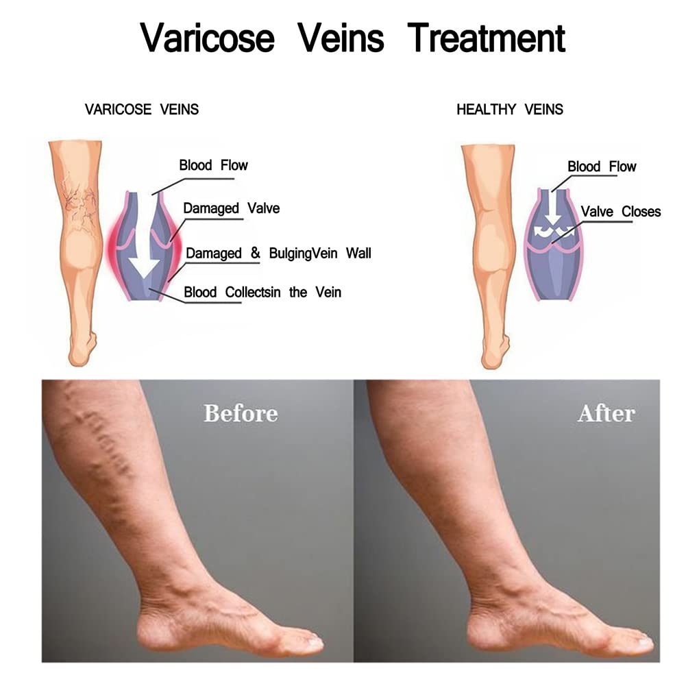 Varicose Veins Miracle Cream - Spider Vein Treatment for Legs | Phlebitis Relief & Muscle Soreness Solution | Fast-Acting Leg Cramp Relief | Perfect for Daily Use & Post-Workout Recovery