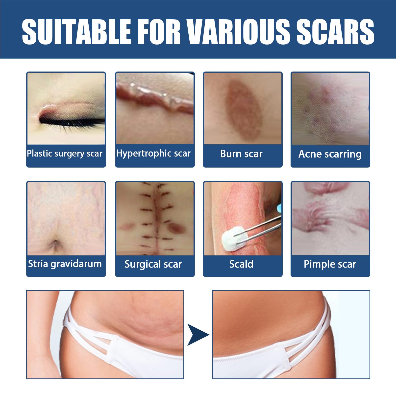 Premium Scar Repair Cream for Face & Body - Medical Grade Scar Removal Treatment for Surgery, Acne, Burns & Injuries - Post-Op Healing Ointment for Smooth Skin Recovery - Ideal for Daily Use After Wounds & Cosmetic Procedures