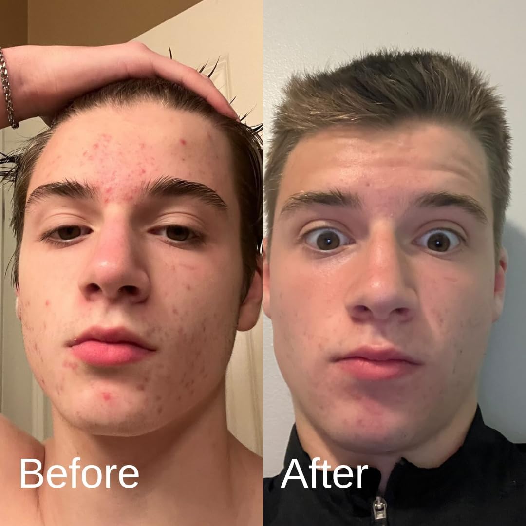 Men's Acne Treatment System - Face Wash, Moisturizer & Pimple Patches | Complete 4-Month Skincare Set for Clear Skin | Perfect for Daily Use & Travel