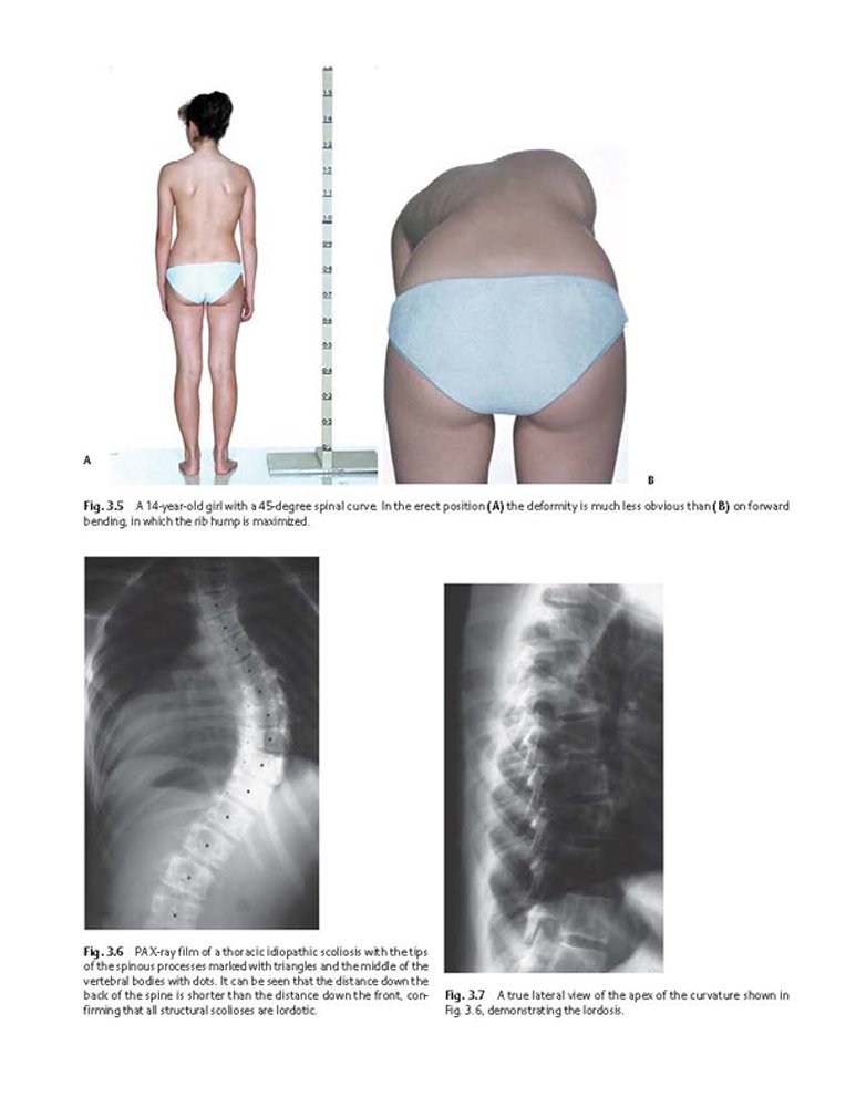 Idiopathic Scoliosis Treatment Guide - Harms Study Group Recommendations for Spinal Correction & Pain Relief | For Doctors, Physical Therapists & Patients
