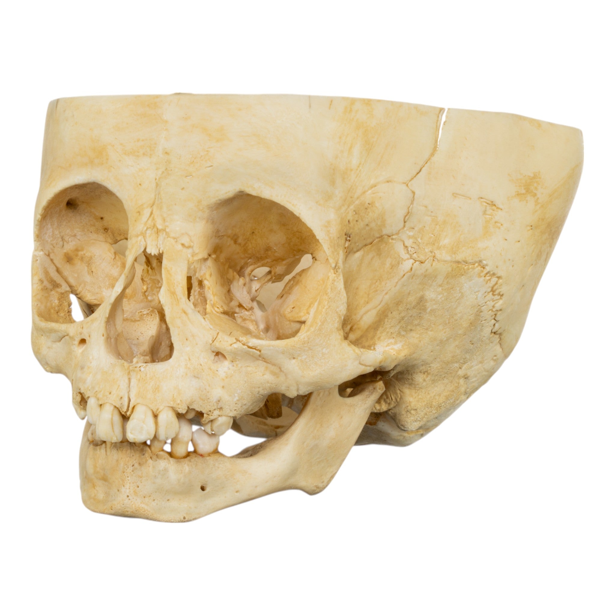 Authentic Real Human Child Skull Specimen - Partial Skull for Medical Study, Anatomy Education & Forensic Research | Ideal for Medical Students, Anthropologists & Science Classrooms