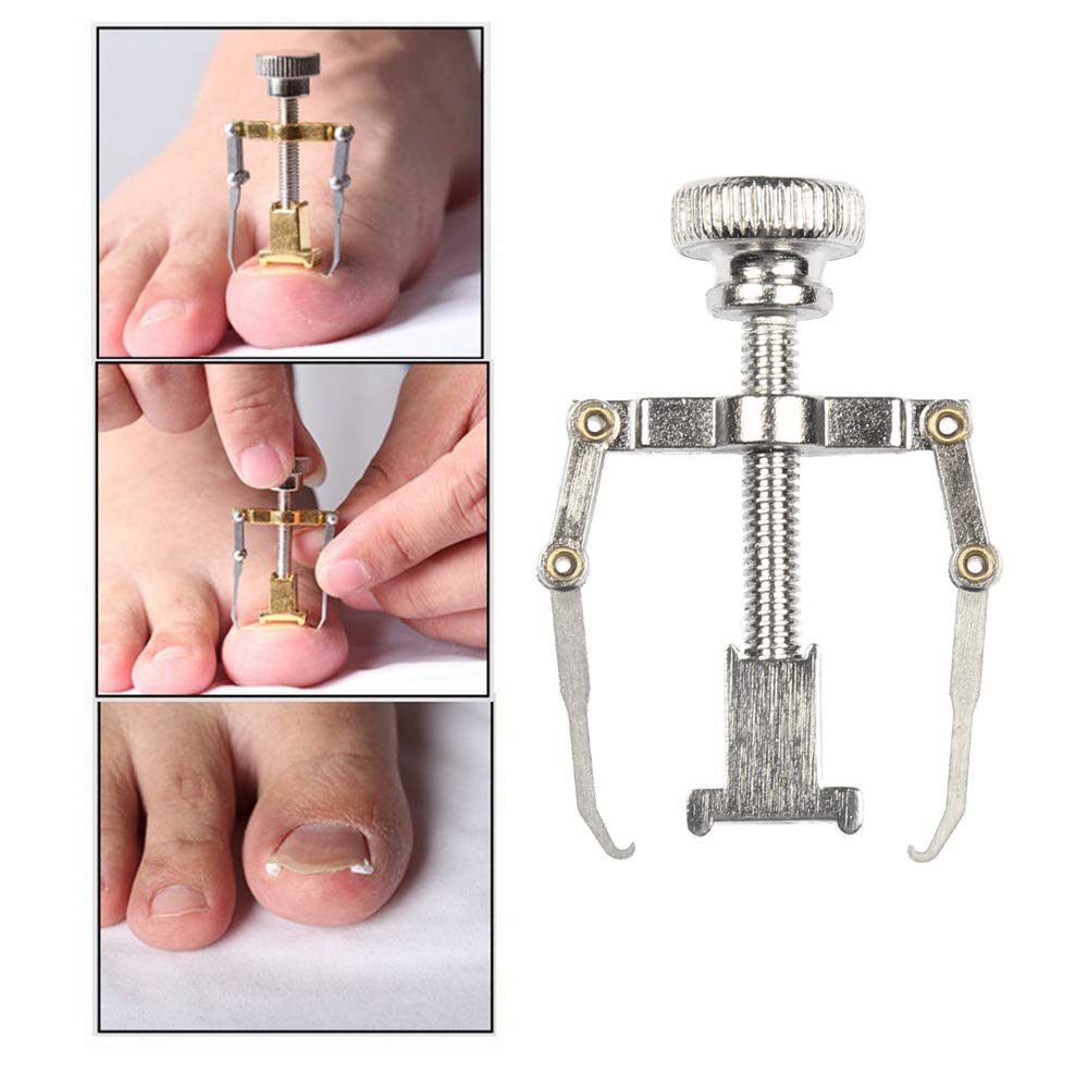 EXCLUZO Nail Correction Kit - Toenail & Fingernail Straightening Treatment with Stickers, Clamp & Lifter - Fix Ingrown, Curved Nails for Healthy Feet & Hands - Perfect for Pedicures, Manicures & Daily Nail Care