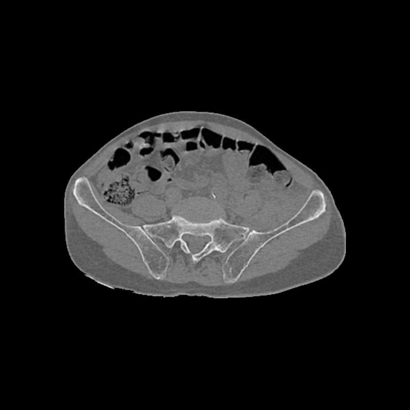 High-Quality Femoral Neck Fracture Pelvis Phantom for CT Scan & X-Ray Training - Perfect for Medical Education & Radiology Practice