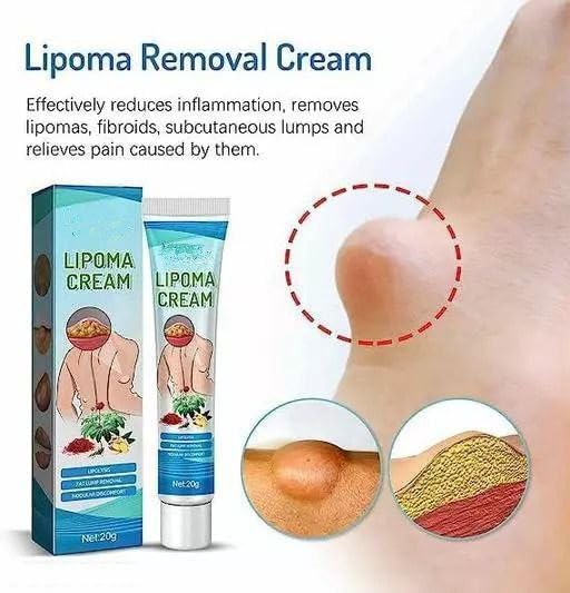 Lipoma Removal Cream - Fast Acting Lipoma Treatment Ointment for Lipoma Elimination & Cellulite Reduction - Anti-Swelling Lymphatic Massage Cream (3 Pack) - Perfect for Home Use & Professional Skin Care