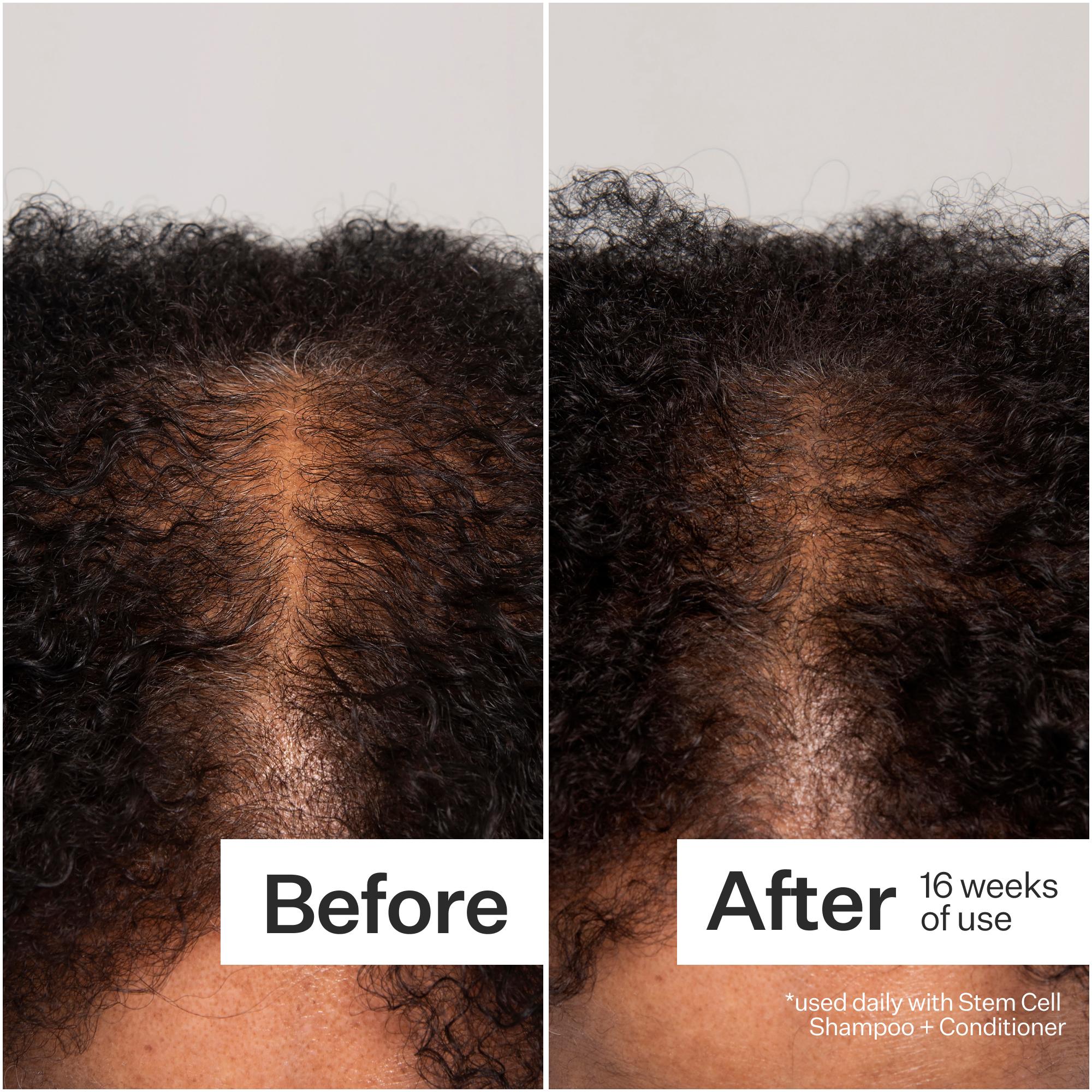 Act+Acre 3% Stem Cell Peptide Hair Treatment for Thinning Hair - Stimulates Hair Growth & Reduces Breakage - Perfect for Daily Scalp Care & Hair Regrowth Routine