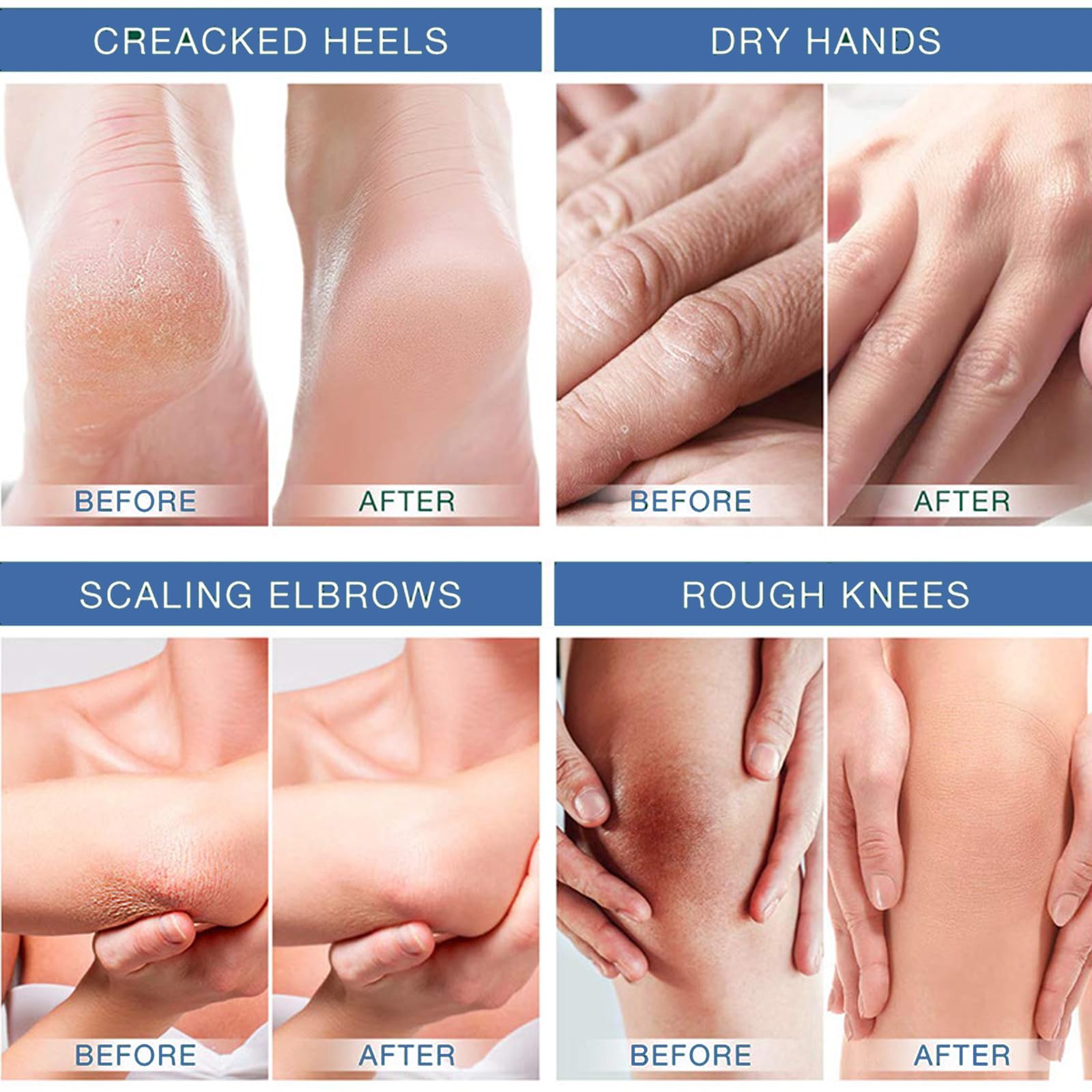 **40% Urea Foot Cream for Dry Cracked Feet – Callus Remover & Moisturizer for Heels, Knees, Elbows & Hands – Softens Rough Skin & Exfoliates Calluses – Perfect for Pedicures & Daily Foot Care**