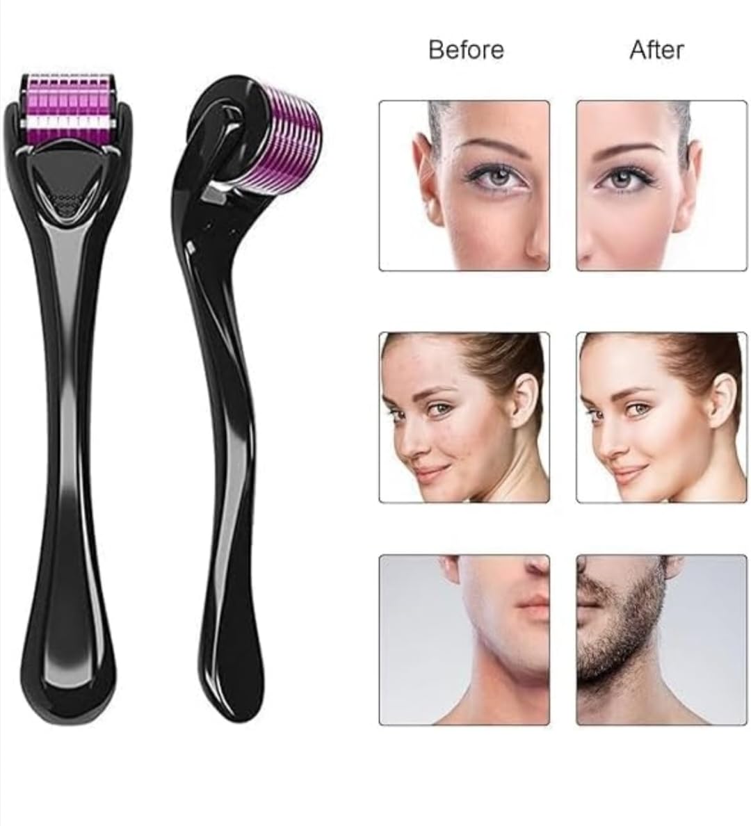 Akhirah 2-Piece 0.5mm Derma Roller with 540 Titanium Needles for Hair Growth & Thickening | Repairs Damaged Hair, Activates Follicles | Reduces Acne Scars | Safe & Effective Skincare & Hair Care Tool | Perfect for Home Use & Salon Treatments - Pack of 2
