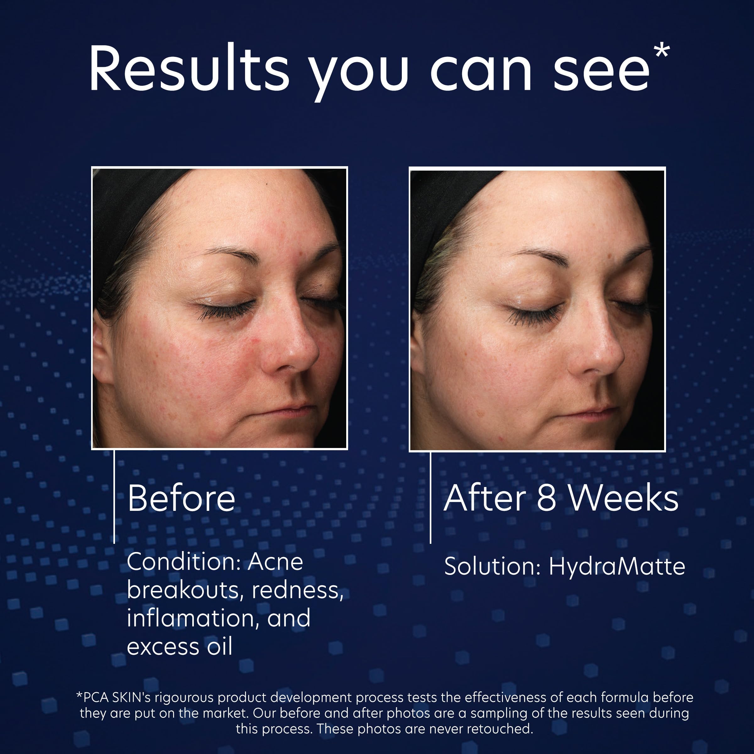 PCA SKIN HydraMatte Oil Control Moisturizer for Oily & Combination Skin - Lightweight Face Moisturizer Reduces Shine & Pores, Fast Absorbing, Non-Greasy Formula - Perfect for Daily Skincare Routine & Makeup Prep (1.8 oz Jar)