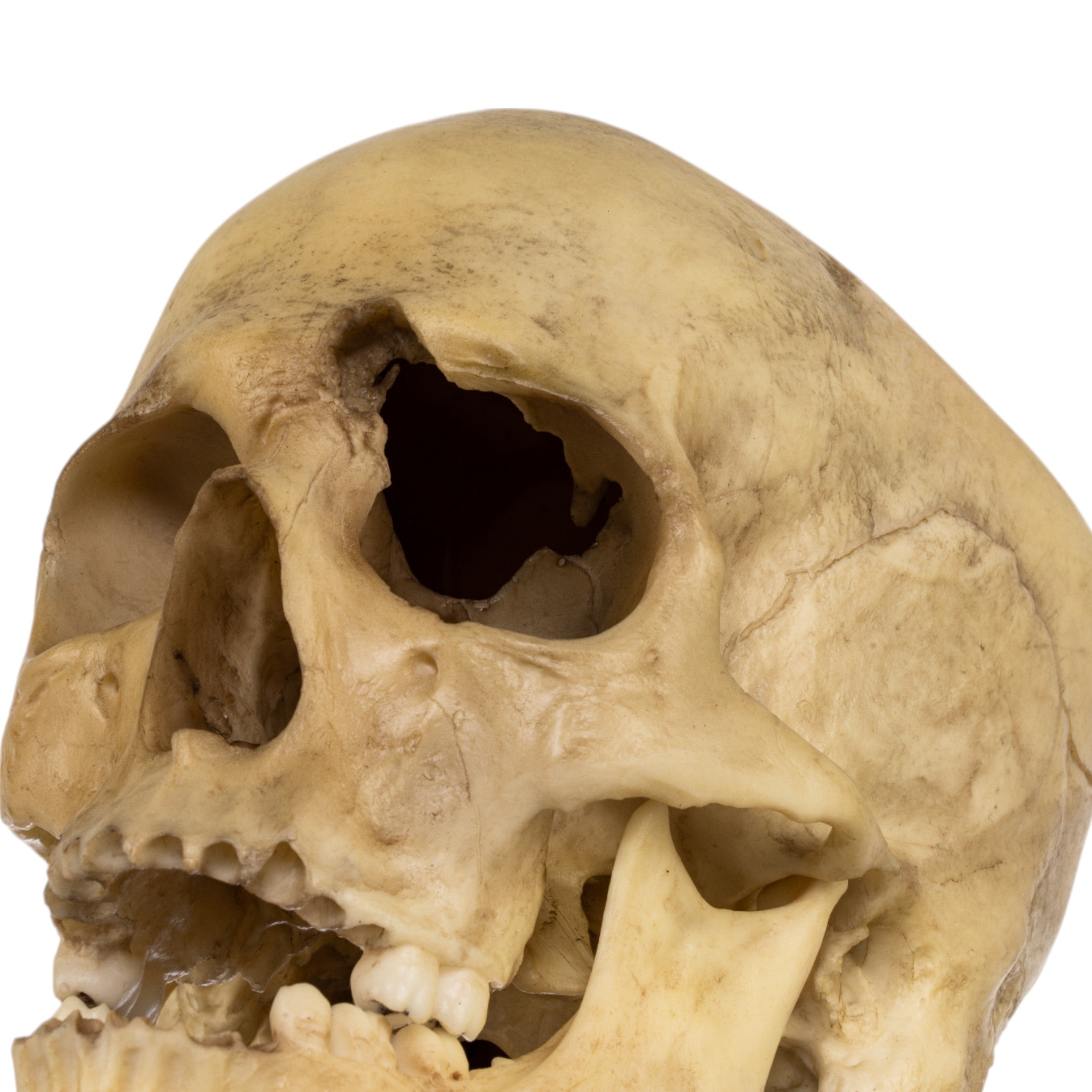 Realistic Replica Human Male Skull with 32 Caliber Gunshot Wound - Perfect for Medical Training, Forensic Studies, and Halloween Decorations