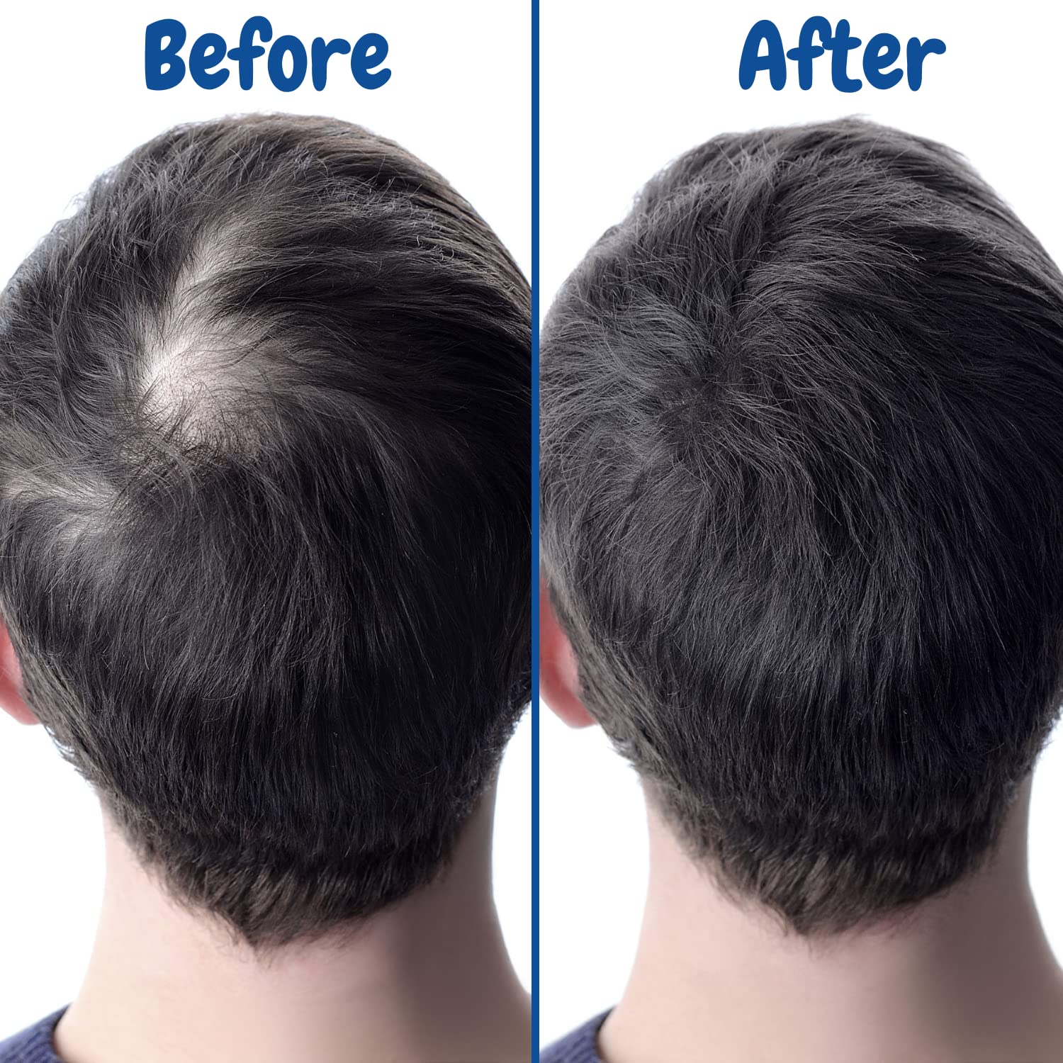 Verseo Sup Hair Growth Conditioner Treatment for Thinning Hair & Hair Loss | Repair Damaged Hair | 28 Day Supply | Perfect for Daily Use & Salon-Quality Results at Home