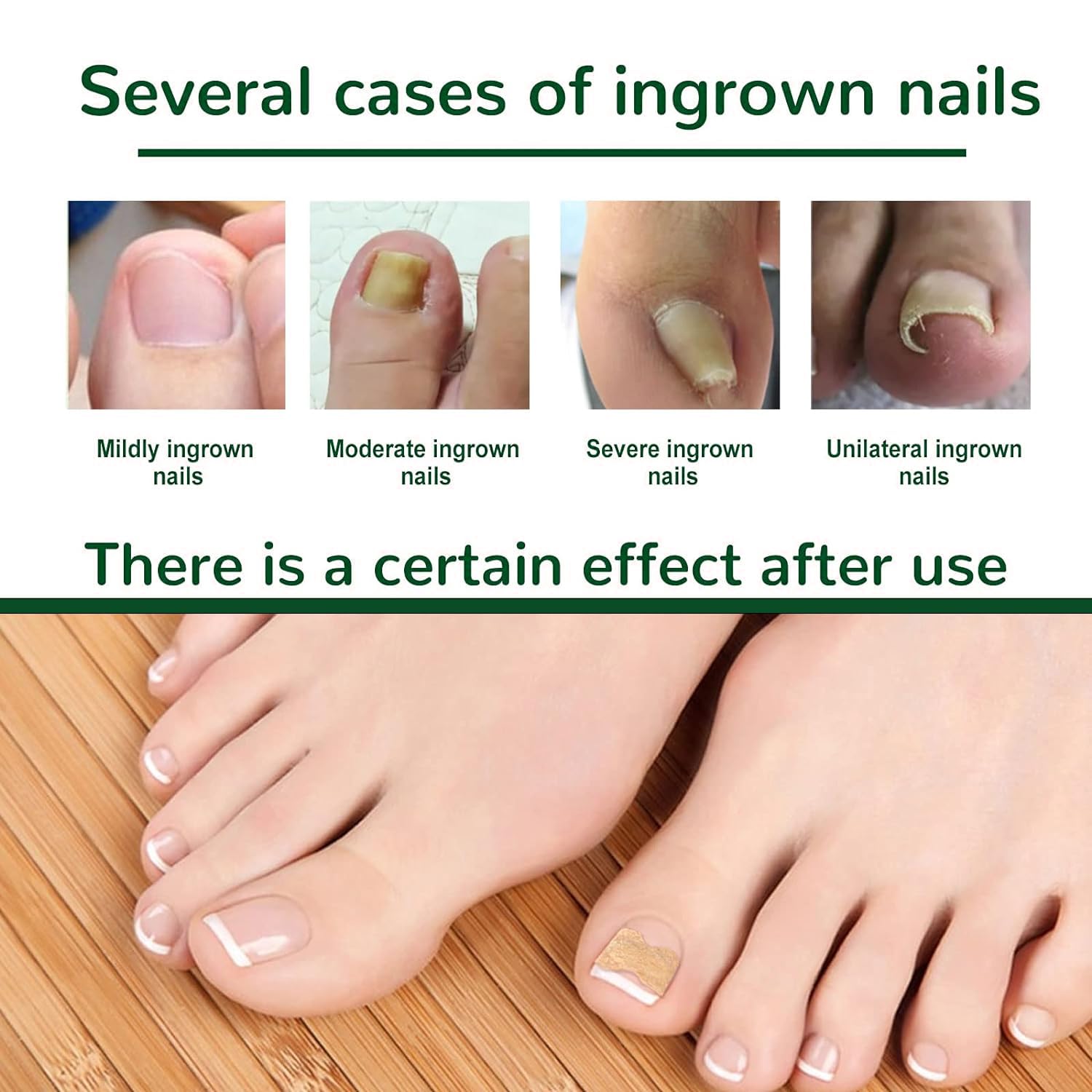 50 Pcs Ingrown Toenail Corrector Patches - No Glue Breathable & Painless Nail Correction Treatment, Stays on Securely for Quick Repair | Ideal for Athletes, Runners & Daily Comfort