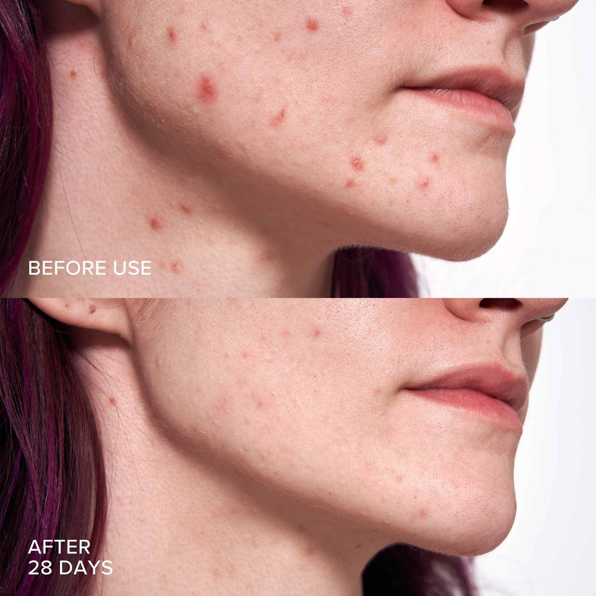 2% BHA + Borage Oil Pore Perfecting Liquid - Exfoliating Facial Treatment for Blackheads & Acne - Perfect for Oily & Combination Skin Care Routine