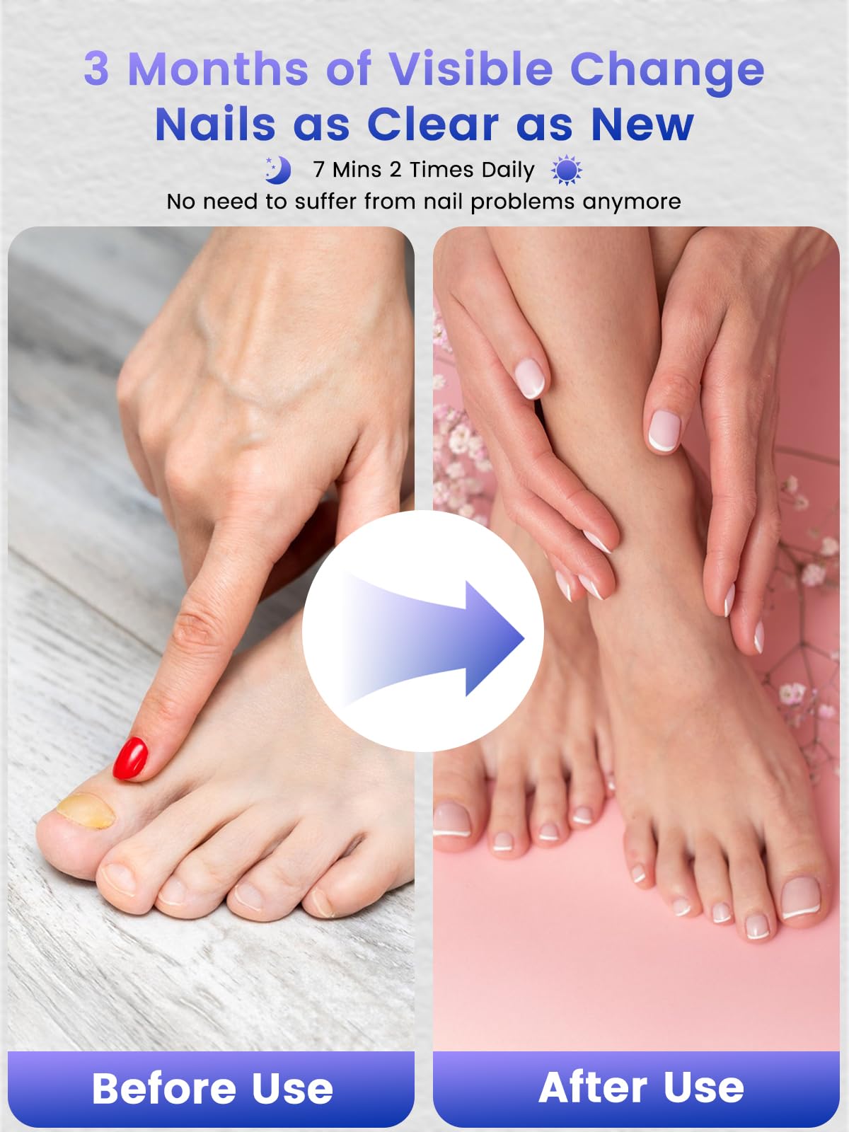 2025 Upgraded Portable Nail Fungus Treatment Light Device - Effective LED Therapy for Toenail & Fingernail Fungus, Discolored & Thick Nails - Home & Travel Use for Healthy Nails