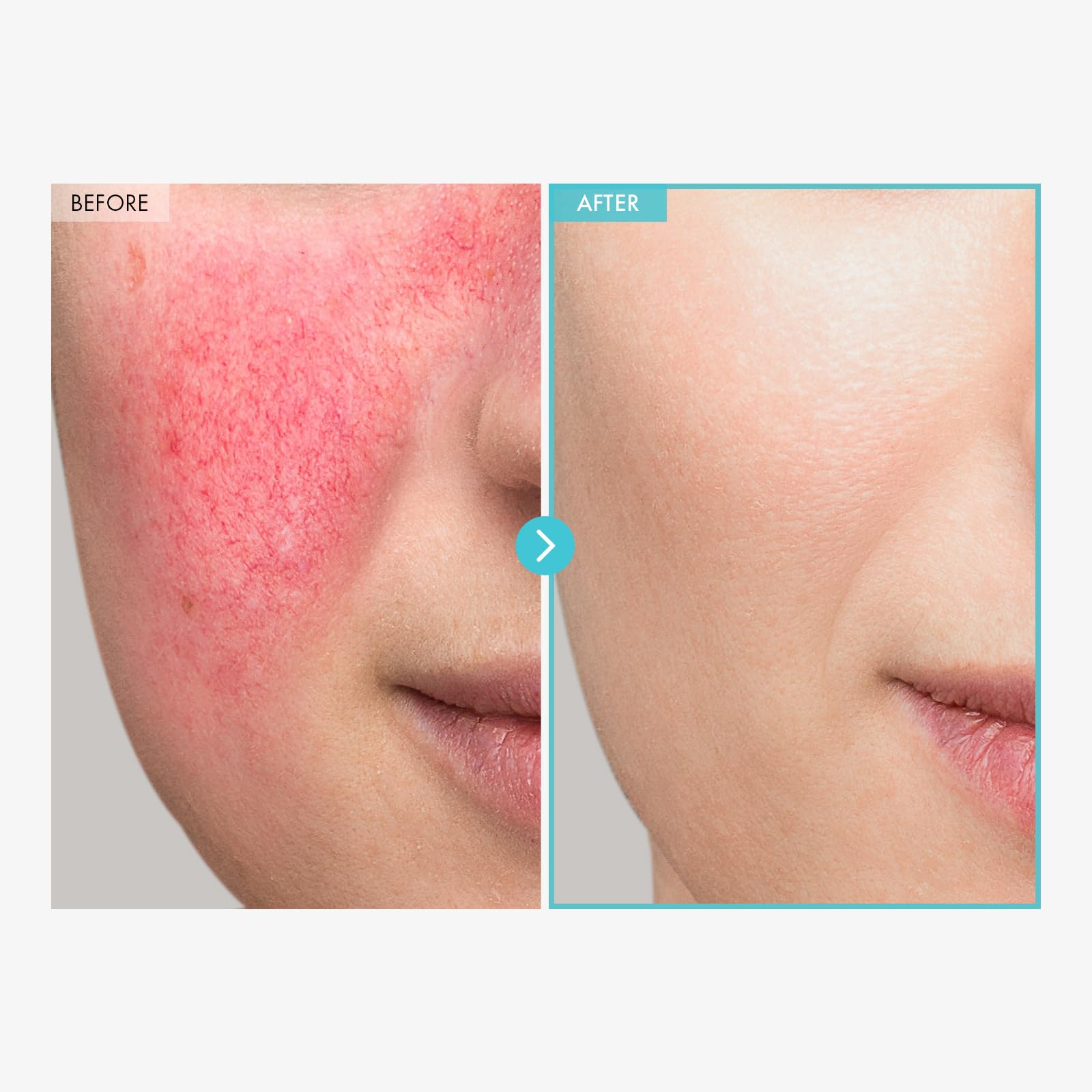 SOS Repair CICA Clinic Zinc Cream - 100,000ppm Zinc Oxide for Acne, Redness & Rosacea Treatment | Skin Barrier Repair & Moisturizing Cream | Non-Comedogenic Korean Skincare (50g/1.76oz) | Perfect for Daily Skin Care & Post-Procedure Healing