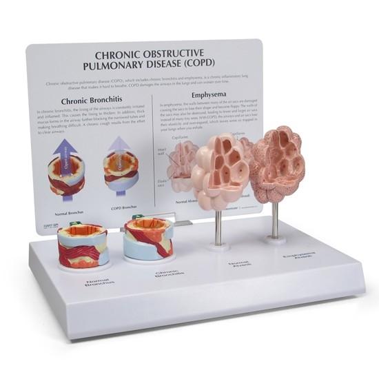 COPD 4-Piece Enlarged Anatomical Model - Medical Education Tool for Respiratory Disease Study & Classroom Demonstration