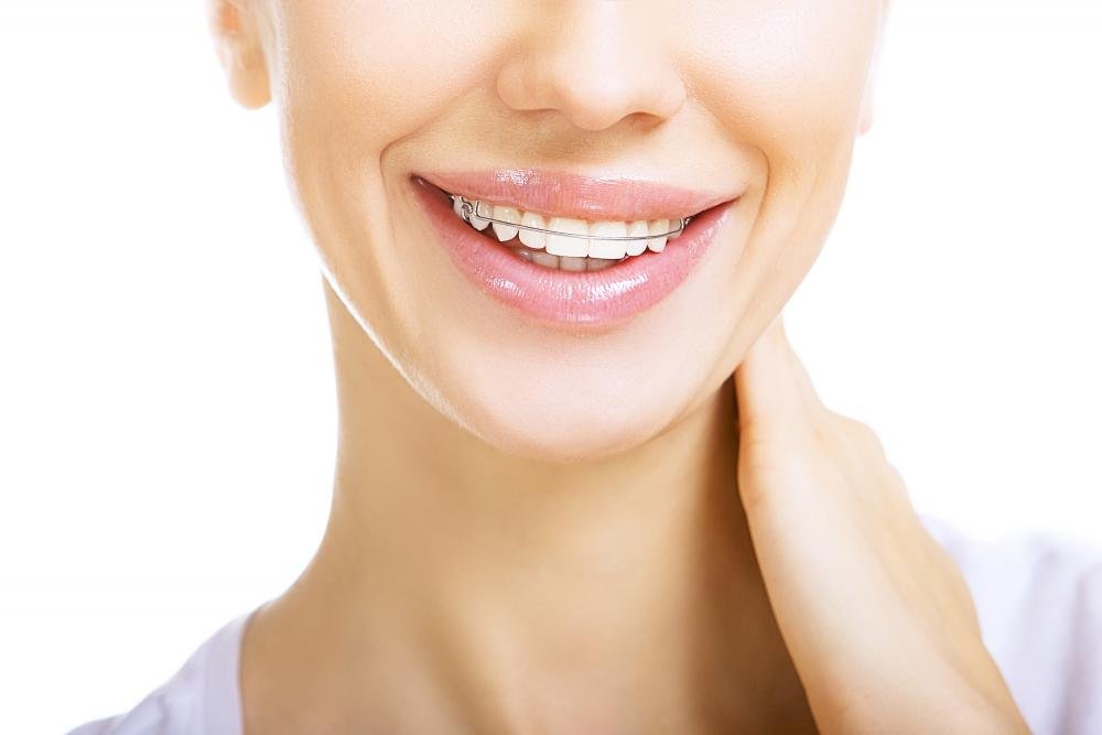 Beautiful Smiling Girl with Retainer Teeth Wall Decal - 24x16 Inch Peel & Stick Wall Art Graphic by Wallmonkeys WM300273 - Perfect for Kids' Rooms, Dental Offices & Home Decor