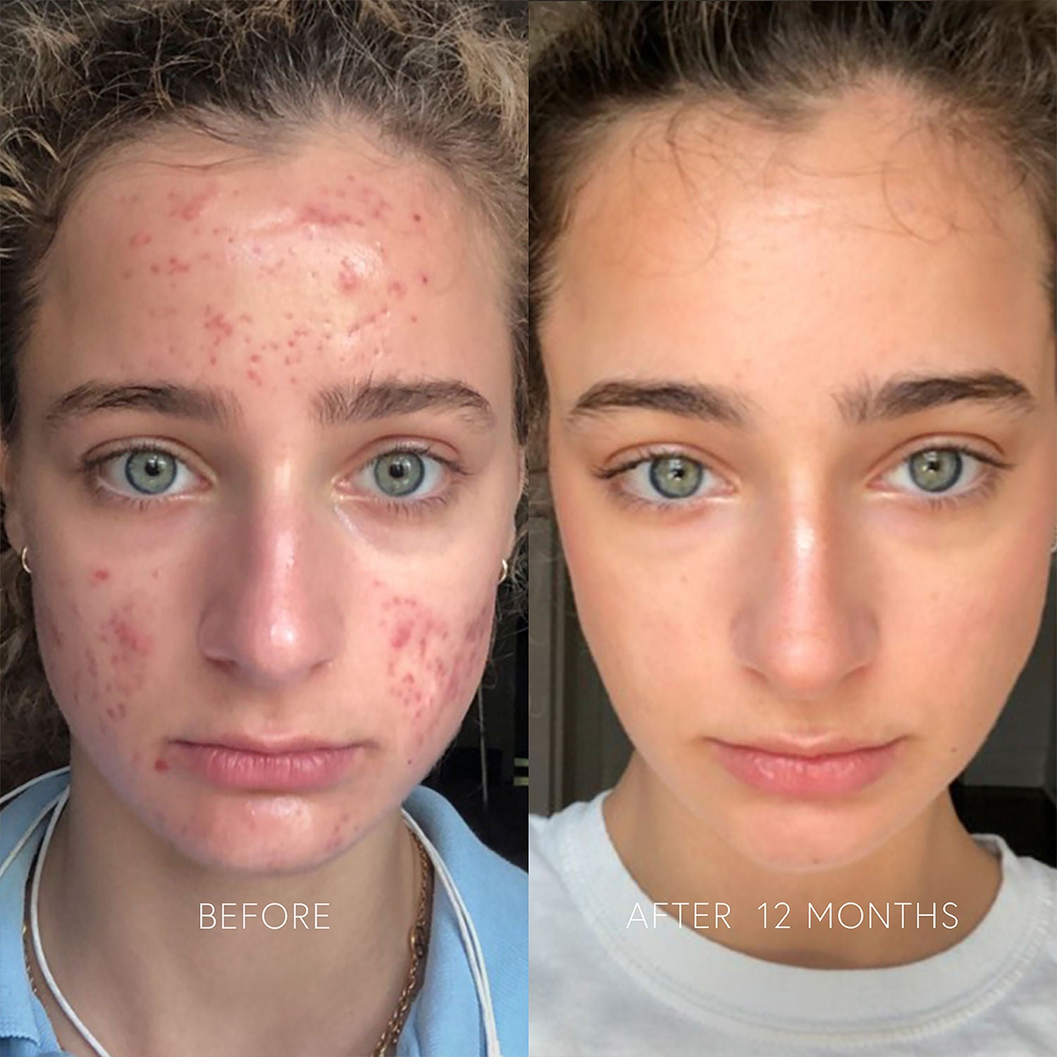 Clarifying Face Cream for Acne & Dark Spots - Brightening Moisturizer for Clear, Glowing Skin | Perfect for Daily Skincare Routine & Nighttime Use