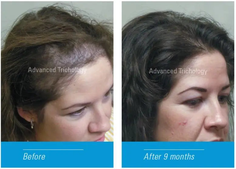 FoliGROWTH Ultimate Hair Growth Supplement - Natural Nutraceutical for Thicker, Stronger Hair | Perfect for Men & Women with Thinning Hair or Hair Loss