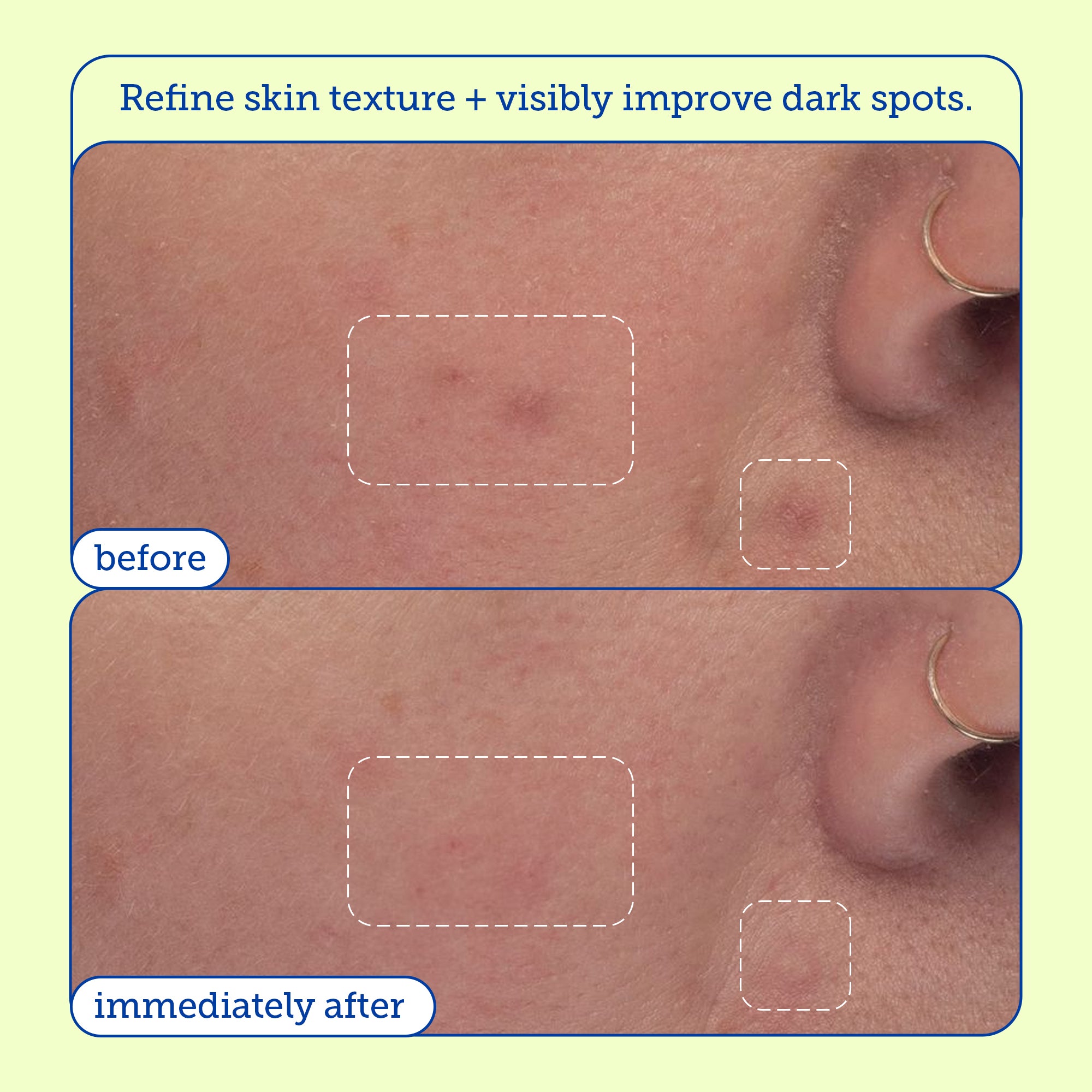 Resurface+ AHA/BHA Niacinamide Exfoliating Pads for Acne, Dark Spots & Pores - Exfoliating Face Pads for Clear Skin - Perfect for Daily Skincare Routine & Travel