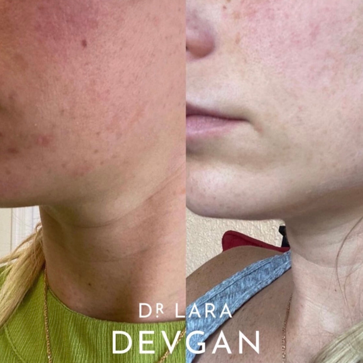 Dr. Devgan Vitamin C + B + E Ferulic Acid Serum for Face - Brightening, Anti-Aging & Hydrating Skincare Treatment - Perfect for Morning Routine & Sun Protection