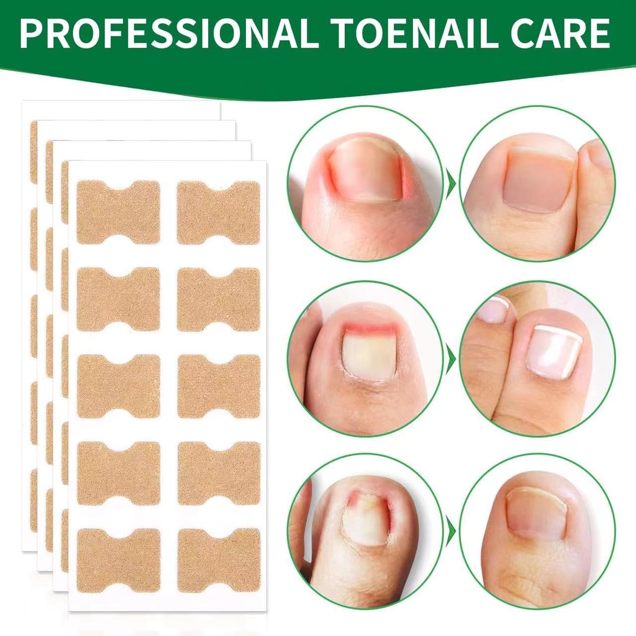 50 Pcs Ingrown Toenail Corrector Patches - Breathable, Painless & No Glue Nail Correction Treatment - Stays Secure, Fast Relief for Ingrown Nails - Perfect for Athletes, Runners & Daily Comfort