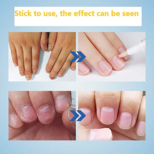 Herbal Nail Repair Pen - Nail Treatment for Stronger Fingernails & Toenails with Rich Nutrients (4 Pack) | Perfect for Damaged Nails, Manicures & Pedicures at Home
