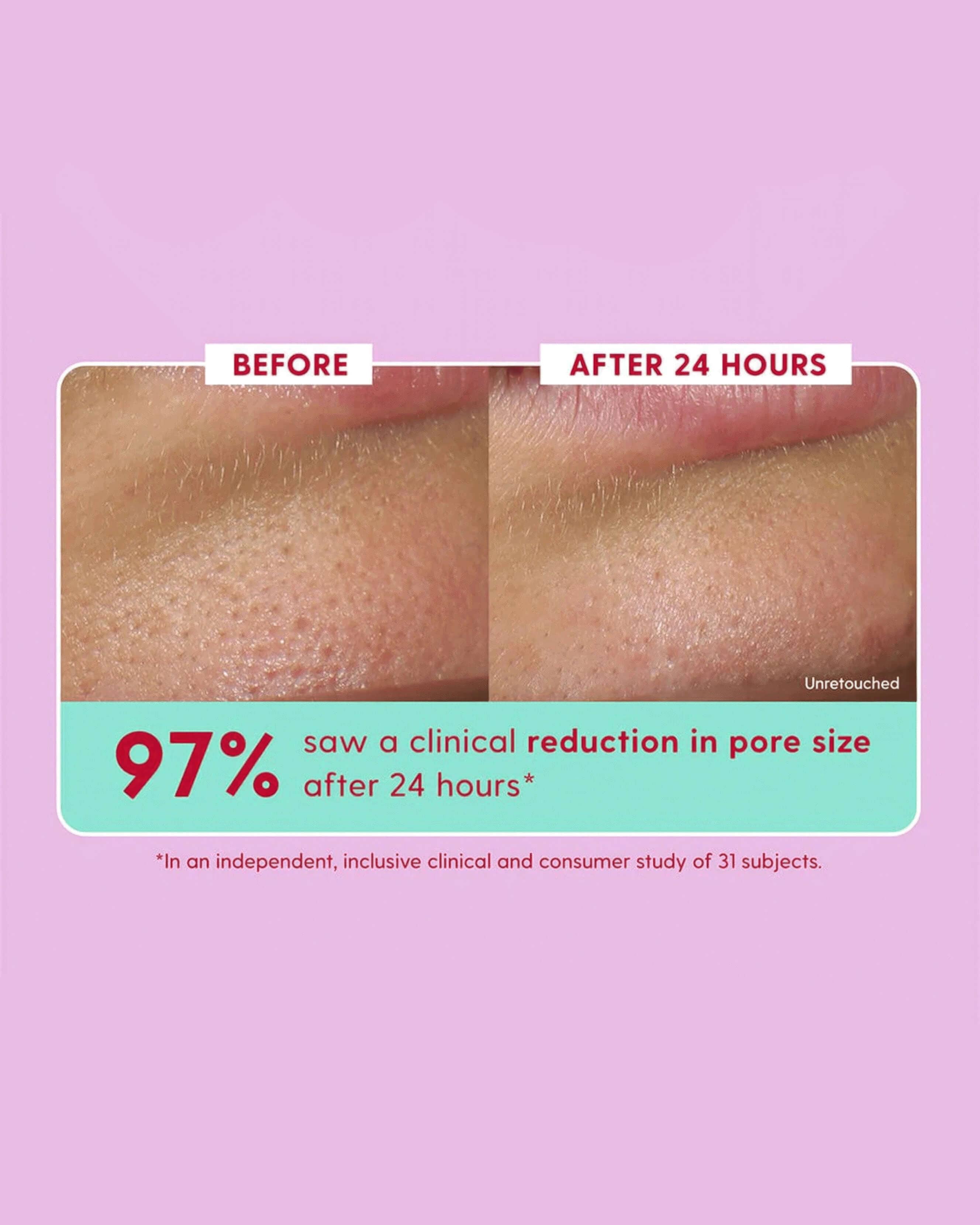10% Glycolic Acid Face Serum for Exfoliation & Skin Renewal - Brightening Treatment for Acne, Wrinkles & Dark Spots - Daily Use for Glowing Skin