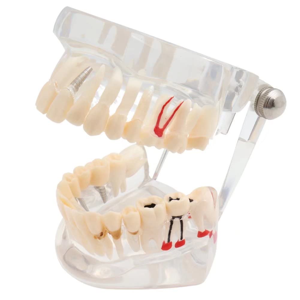 Dental Implant Model - 1Pc Teeth Restoration Bridge for Dentist Training, Study & Research | Perfect for Dental Education, Patient Communication & Practice