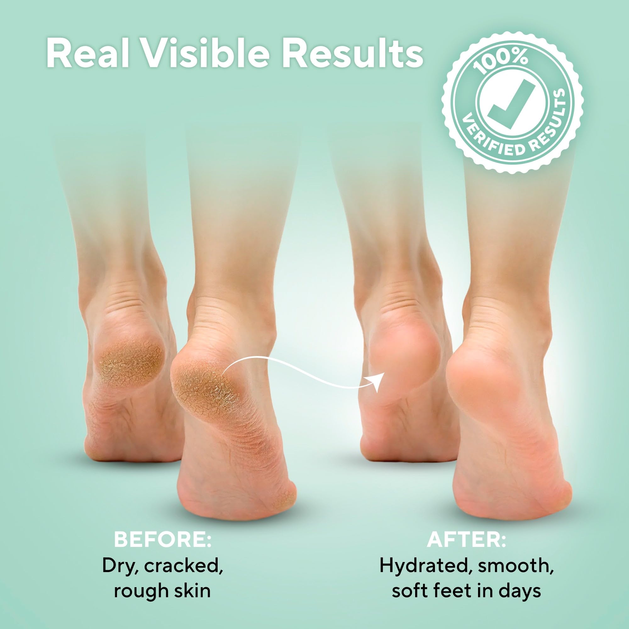 Lavinso Maximum Strength 40% Urea Foot Cream for Calluses & Cracked Heels - Intensive Moisturizing Treatment for Dry, Rough Skin - Men & Women Foot Care - Perfect for Daily Use & Overnight Repair