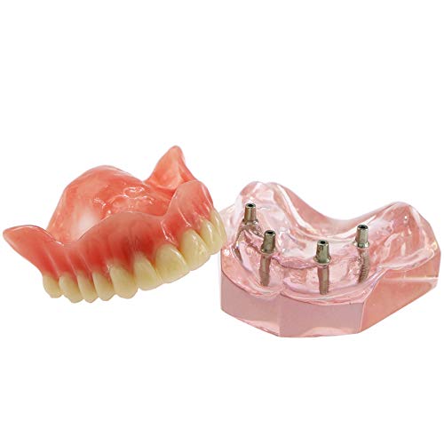 DENTALMALL Transparent Dental Upper Implant Model - Overdenture Superior Teeth Demo for Dental Education & Study Tool (6001P) | Ideal for Classroom Demonstrations & Clinical Training