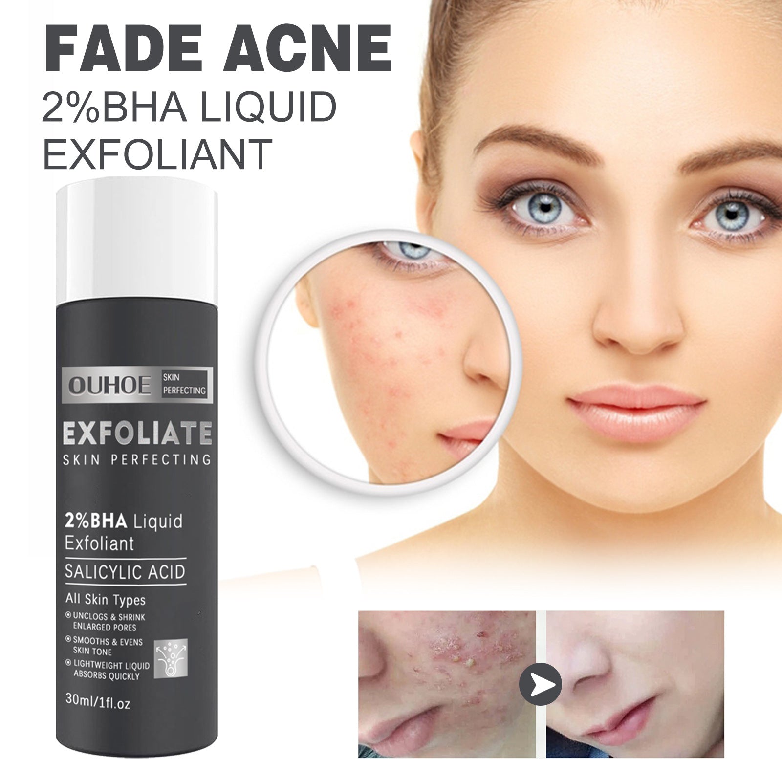Salicylate Acne Treatment Cream - Skin Repair & Care for Clear Complexion | Perfect for Daily Skincare Routine & Blemish Control