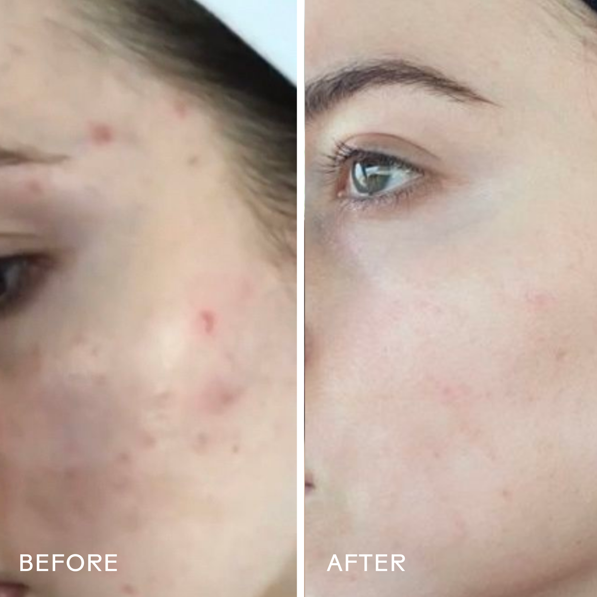 Dew Drops Mushroom & Kakadu Plum Hyaluronic Acid Serum for Face - Hydrating Anti-Aging Facial Treatment for Dry, Sensitive Skin | Day & Night Moisturizer for Glowing Complexion
