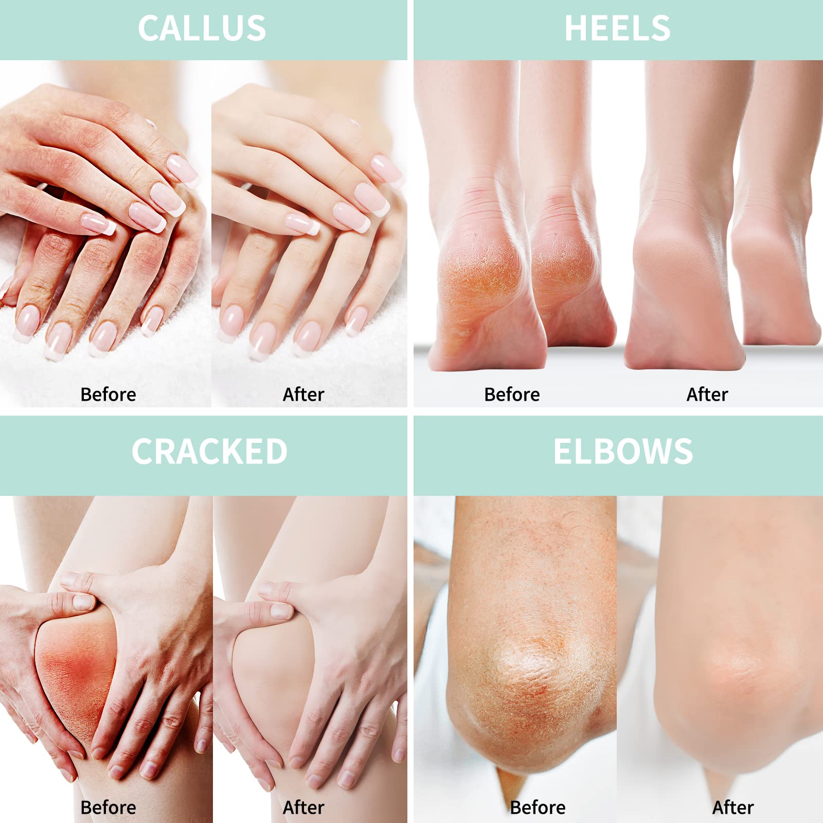 20% Urea Cream with 2% Salicylic Acid - 150g Maximum Strength Foot & Hand Moisturizer - Infused with Hyaluronic Acid, Tea Tree & Aloe Vera for Deep Hydration | Cracked Heel Treatment, Dry Skin Relief for Calluses & Rough Feet