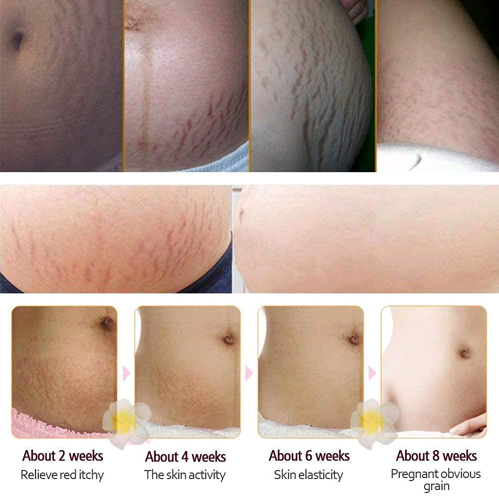 RtopR Mango Stretch Marks & Scar Removal Cream for Pregnancy - Best Body Moisturizer for Smooth Skin - 80g - Perfect for Postpartum Care & Skin Repair