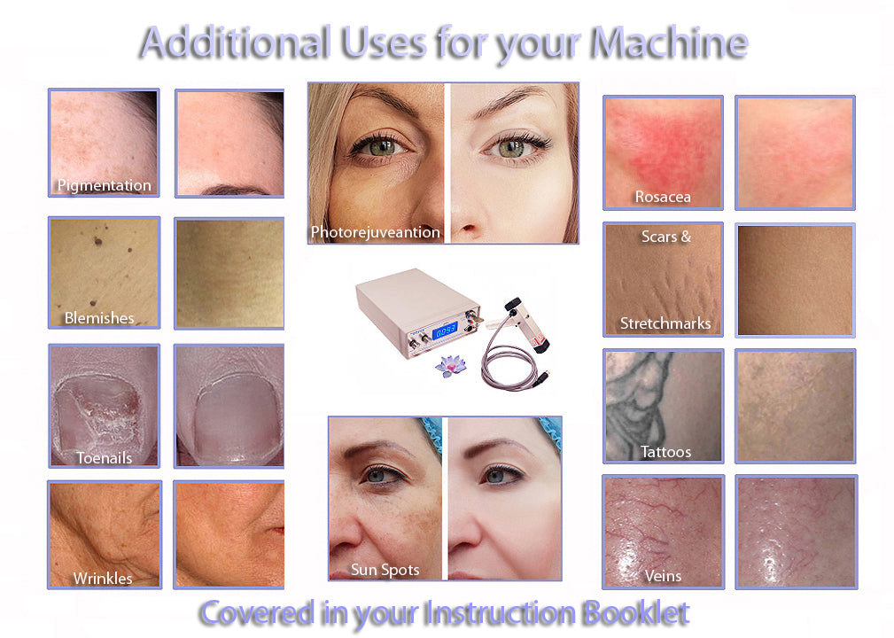 SDL50 Laser System for Permanent Hair Removal, Vein Reduction, Age Spot & Hyperpigmentation Treatment - Professional At-Home IPL Device for Smooth Skin | Perfect for Face, Legs, Arms & Bikini Line