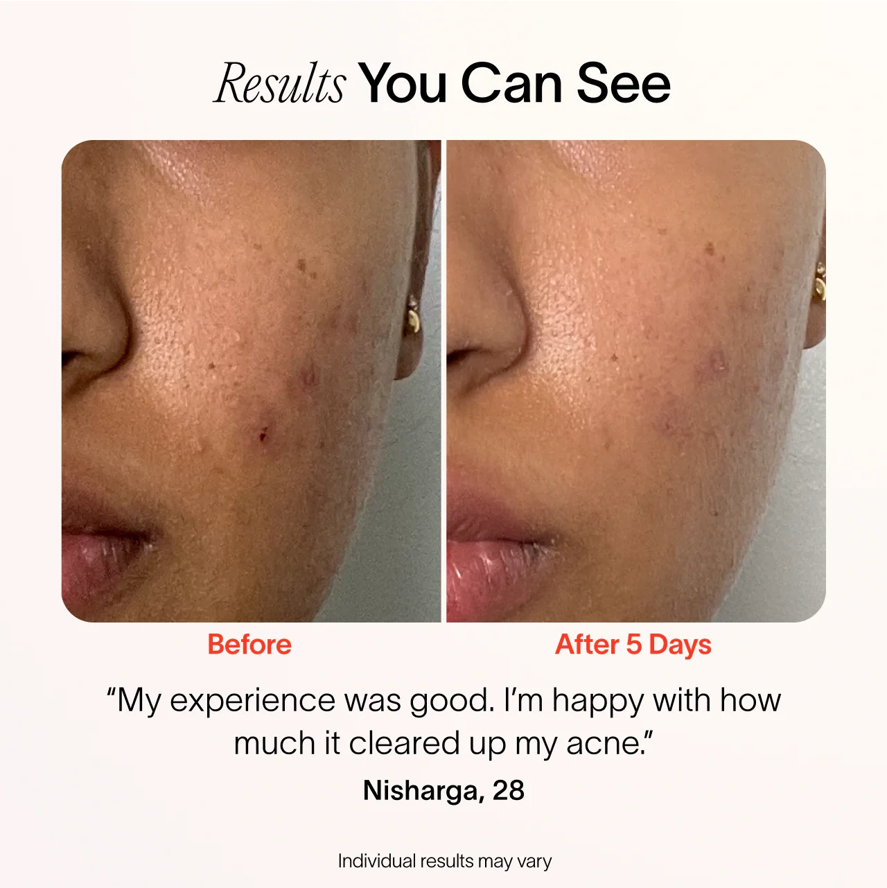 Bye Acne: Fast-Acting 3 Minute Pimple Spot Treatment for Clear Skin | Perfect for Overnight Use & On-The-Go Acne Care