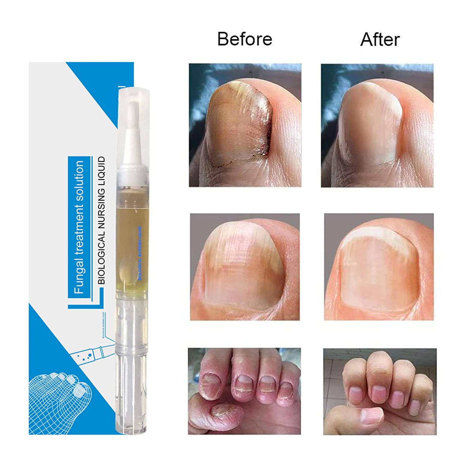 Okita Toenail Fungus Treatment Pen - Fast-Acting Antifungal Nail Repair for Toenails & Fingernails - Clinically Proven Fungus Eliminator (3 Pack) - Perfect for Athletes, Swimmers & Daily Foot Care