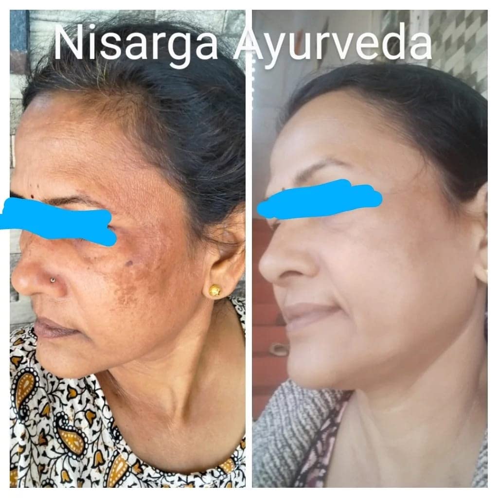 Nisarga Ayurveda Pigmentation Face Pack - Natural Treatment for Tanning, Melasma & Dark Spots, Reduces Scar Marks, UV Protection for Radiant Skin - Pack of 2 (100g Each) | Perfect for Daily Skincare & Sun Damage Repair